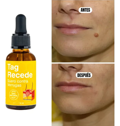 Eliminador de Verrugas y Lunares